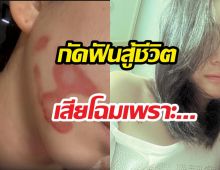 ดาราสาว เผยรอยแผลหน้าเสียโฉม ไม่ท้อสมัครงานหาเงินรักษา